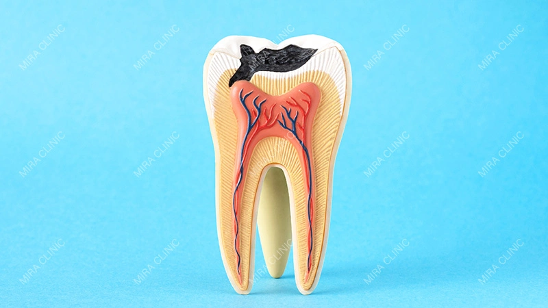 Broken Tooth With a Healthy Root